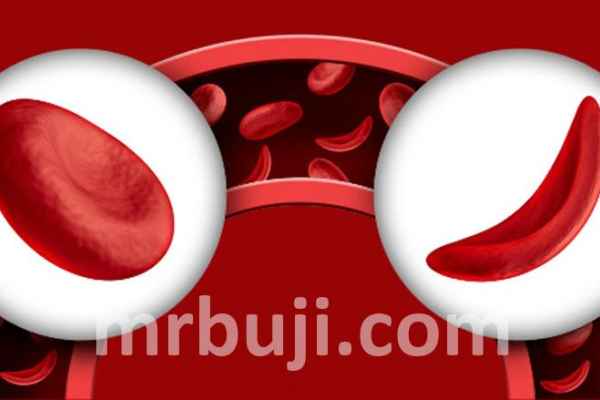 Hope Through Progress: Advancing Sickle Cell Care Globally