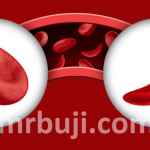 Hope Through Progress: Advancing Sickle Cell Care Globally